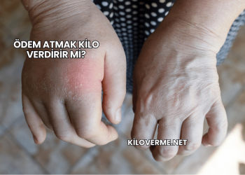 Ödem Atmak Kilo Verdirir mi?