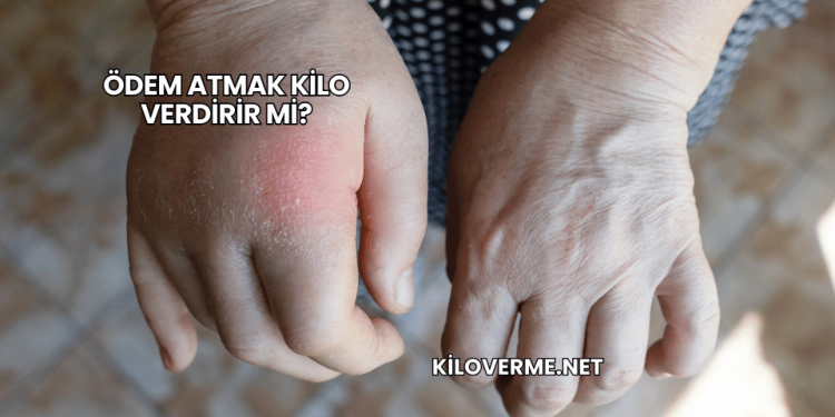 Ödem Atmak Kilo Verdirir mi?