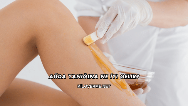 Ağda Yanığına Ne İyi Gelir?