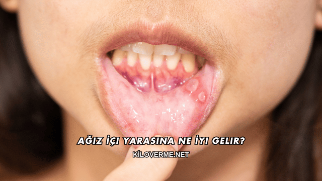 Ağız İçi Yarasına Ne İyi Gelir?
