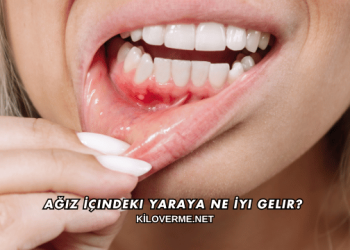 Ağız İçindeki Yaraya Ne İyi Gelir?