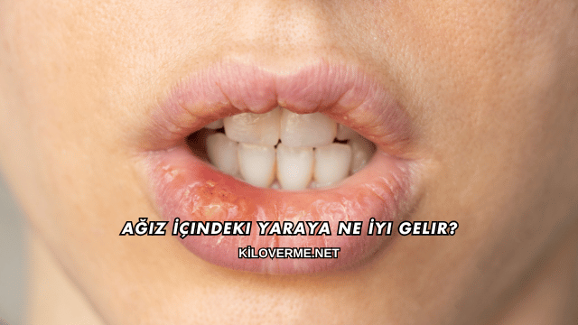 Ağız İçindeki Yaraya Ne İyi Gelir?