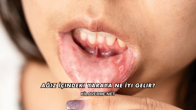 Ağız İçindeki Yaraya Ne İyi Gelir?