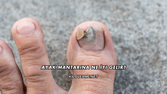 Ayak Mantarına Ne İyi Gelir?