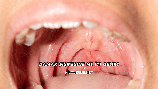 Damak Şişmesine Ne İyi Gelir?