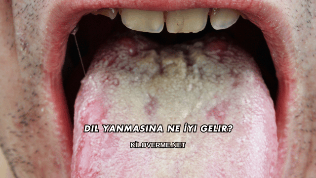 Dil Yanmasına Ne İyi Gelir?