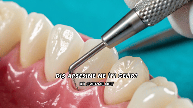 Diş Apsesine Ne İyi Gelir?