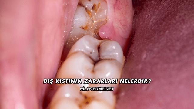 Diş Kistinin Zararları Nelerdir?