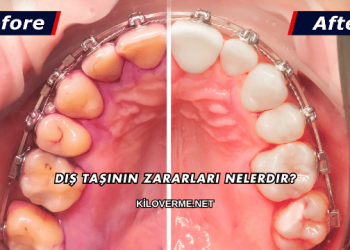 Diş Taşının Zararları Nelerdir?