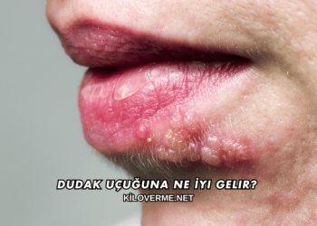 Dudak Uçuğuna Ne İyi Gelir?