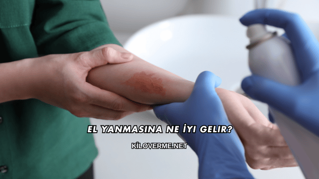 El Yanmasına Ne İyi Gelir?