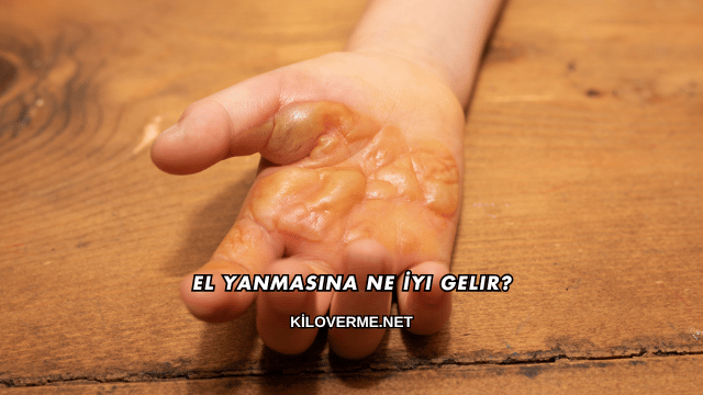 El Yanmasına Ne İyi Gelir?