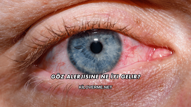 Göz Alerjisine Ne İyi Gelir?