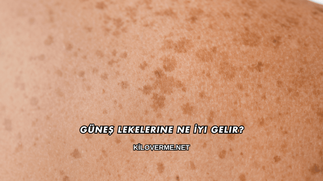 Güneş Lekelerine Ne İyi Gelir?