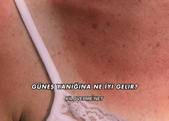 Güneş Yanığına Ne İyi Gelir?