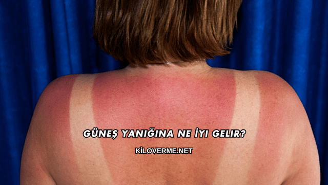 Güneş Yanığına Ne İyi Gelir?