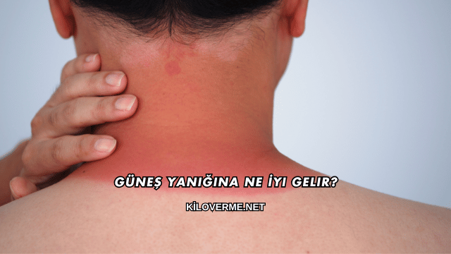 Güneş Yanığına Ne İyi Gelir?