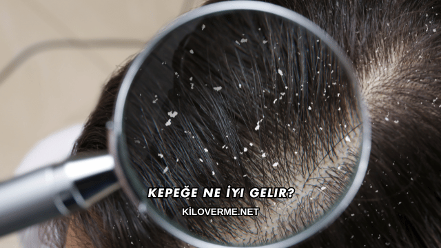 Kepeğe Ne İyi Gelir?