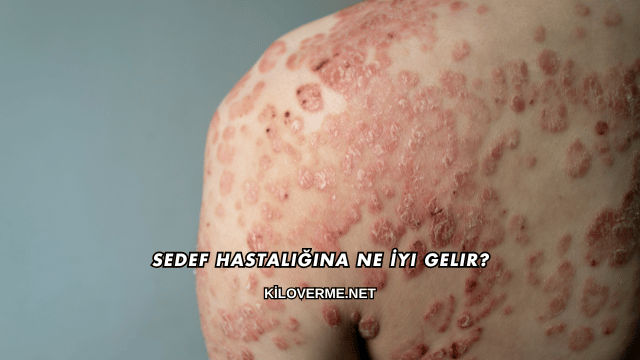 Sedef Hastalığına Ne İyi Gelir?
