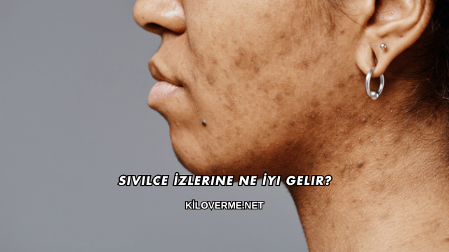 Sivilce İzlerine Ne İyi Gelir?