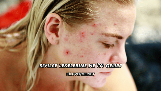Sivilce Lekelerine Ne İyi Gelir?