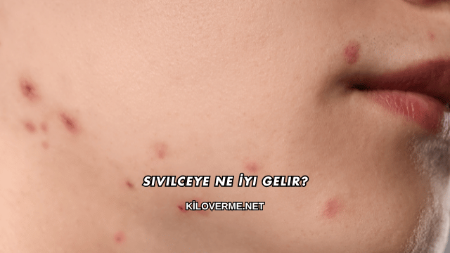 Sivilceye Ne İyi Gelir?