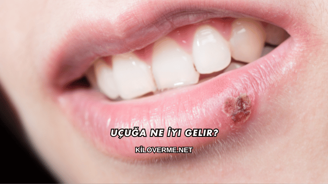 Uçuğa Ne İyi Gelir?