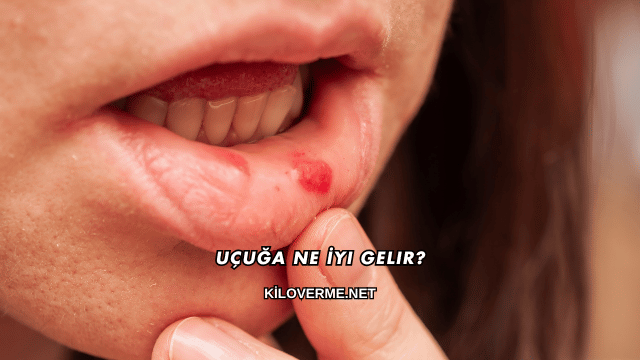 Uçuğa Ne İyi Gelir?