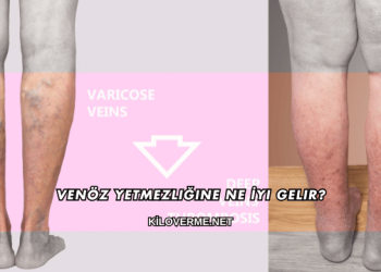 Venöz Yetmezliğine Ne İyi Gelir?