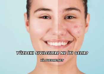 Yüzdeki Sivilcelere Ne İyi Gelir?