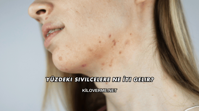Yüzdeki Sivilcelere Ne İyi Gelir?