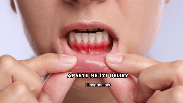 Apseye Ne İyi Gelir?