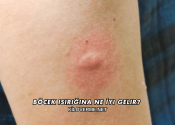 Böcek Isırığına Ne İyi Gelir?