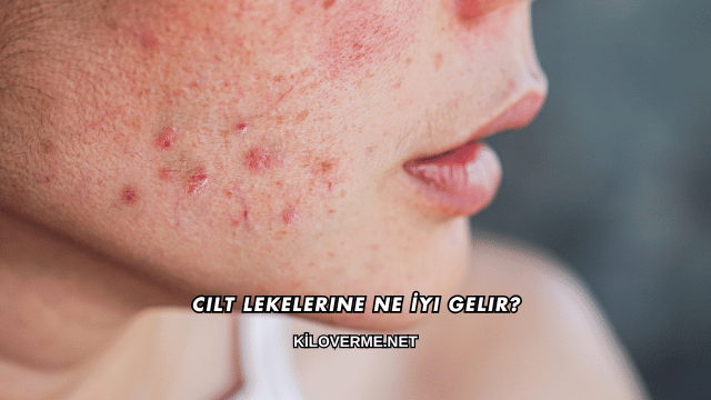 Cilt Lekelerine Ne İyi Gelir?