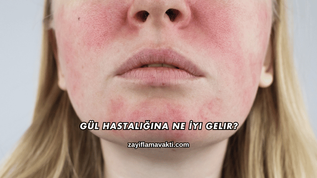 Gül Hastalığına Ne İyi Gelir?