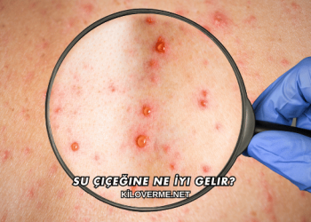 Su Çiçeğine Ne İyi Gelir?