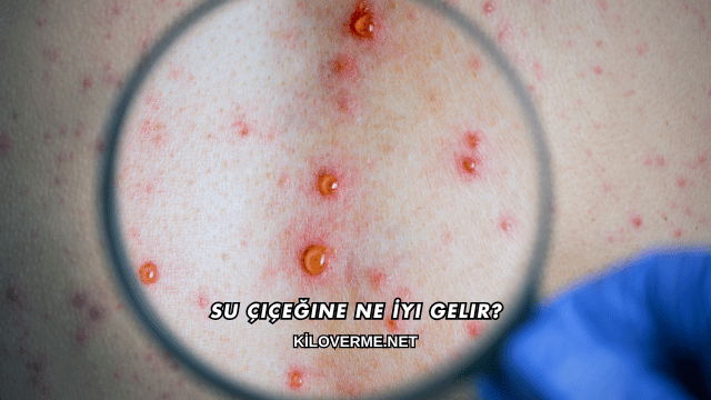 Su Çiçeğine Ne İyi Gelir?