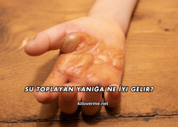 Su Toplayan Yanığa Ne İyi Gelir?