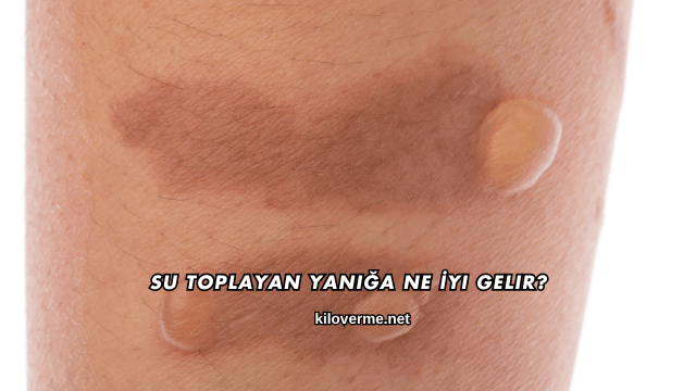 Su Toplayan Yanığa Ne İyi Gelir?