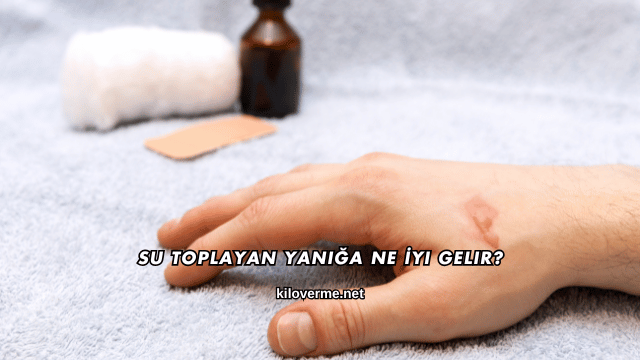 Su Toplayan Yanığa Ne İyi Gelir?