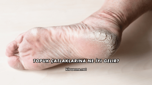Topuk Çatlaklarına Ne İyi Gelir?