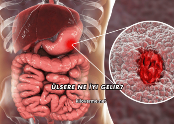 Ülsere Ne İyi Gelir?