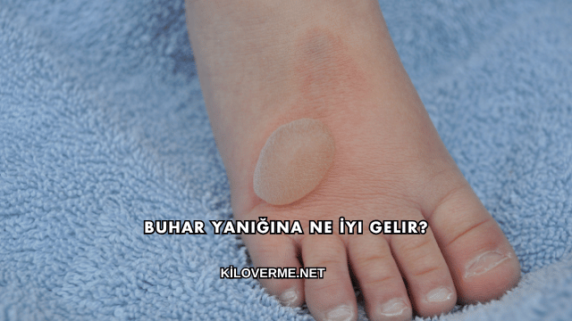 Buhar Yanığına Ne İyi Gelir?