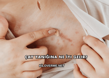 Çay Yanığına Ne İyi Gelir?