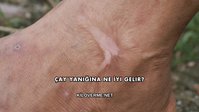 Çay Yanığına Ne İyi Gelir?