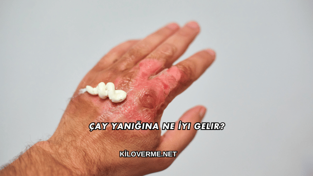 Çay Yanığına Ne İyi Gelir?