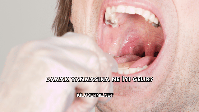 Damak Yanmasına Ne İyi Gelir?