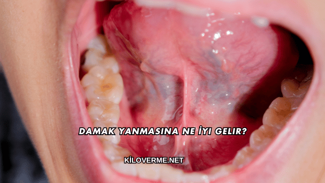 Damak Yanmasına Ne İyi Gelir?