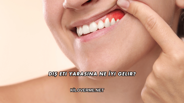 Diş Eti Yarasına Ne İyi Gelir?