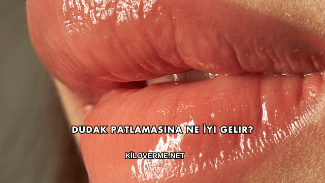 Dudak Patlamasına Ne İyi Gelir?